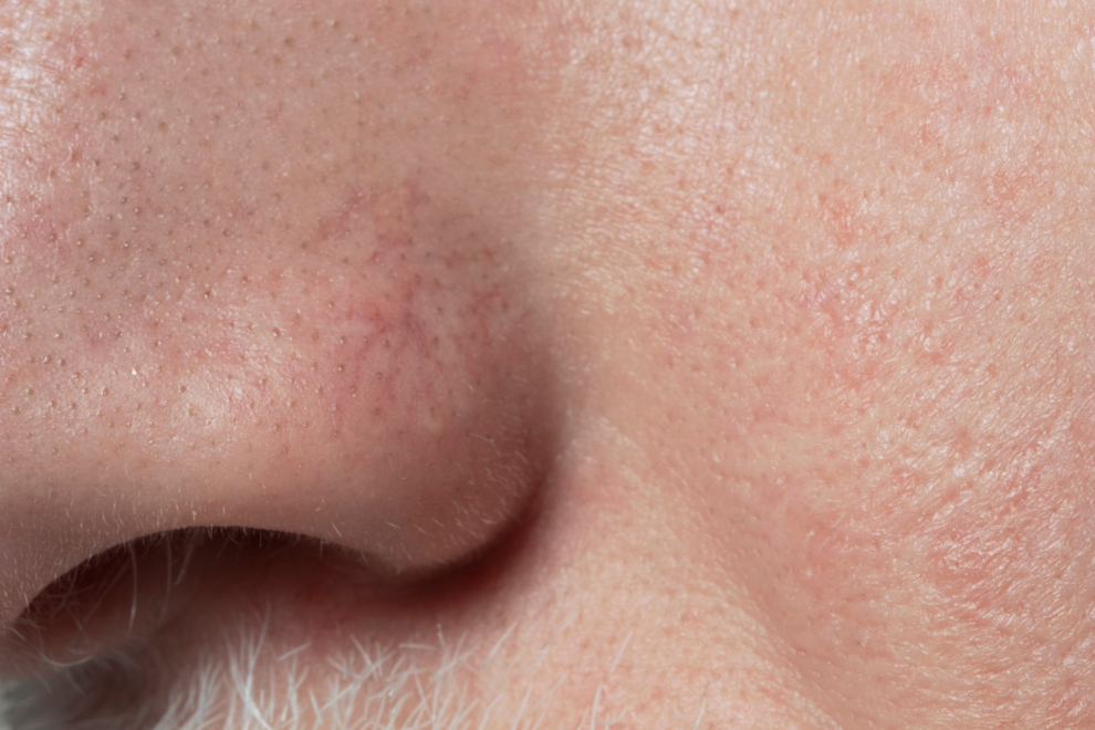 Enlarged Pores